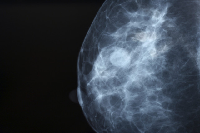Increased Cancer Risk Seen After False-Positive Mammograms